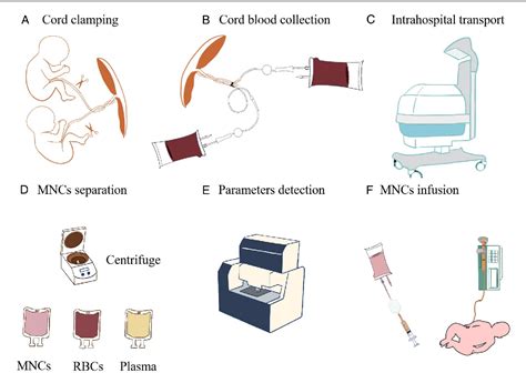 Autologous Cord Blood Mononuclear Cell Infusion For The Prevention Of