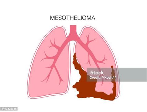 Mesothelioma Cancer Disease Stock Illustration Download Image Now