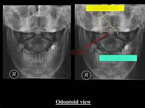 Msk Radiology 33 Diagram Quizlet