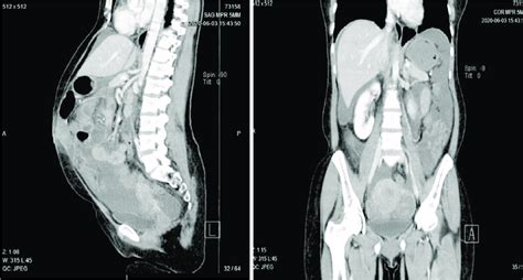 Computed Tomography Showing A Complex Cystic Mass Arising From Left