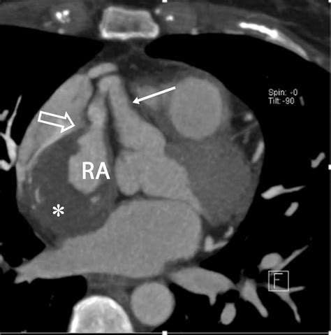 Coronary Artery Fistulas Pathophysiology Imaging Findings And