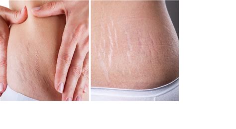 Remove Stretch Marks People Can Try This Creams To Get Beautiful Skin