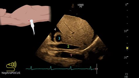 NephroPOCUS On Twitter POCUS Quiz Of The Day Identify The Anechoic