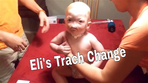 How To Perform A Trach Change On A Toddler Eli Youtube