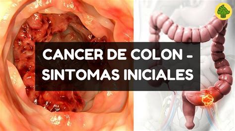 Cuales Son Los Primeros Sintomas Del Cancer De Colon Hot Sex Picture