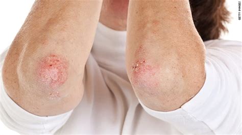 No Heart Risk Seen With Psoriasis Drug