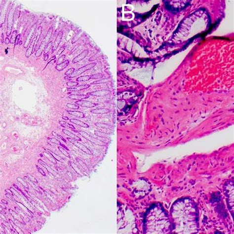 Biopsy Of Resected Polyps From The Transverse Colon Showing A