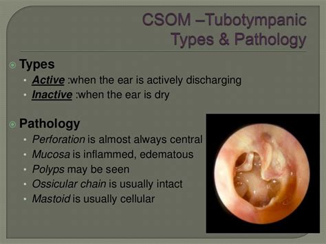 Types Of Otitis Media By Dr Haseeb Ahmed Dec 2011