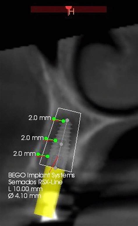 Cbct Para Axial View Showing Preoperative Bone Density Measurements