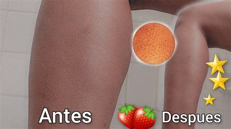 Dile Adiós A Las Piernas De Fresa Con Esta Rutina Controla La Foliculitis Youtube