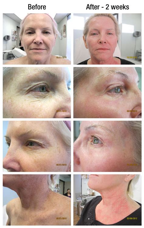 Co2 Skin Resurfacing Valencia Skin Rejuvenation Santa Clarita Skin