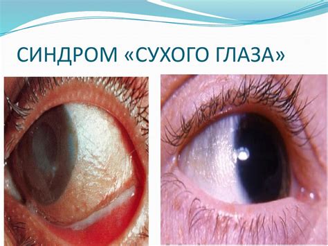 СИНДРОМ СУХОГО ГЛАЗА - ОФТАЛЬМОЛОГИЯ | Добро пожаловать в «Клинику Айгерим»