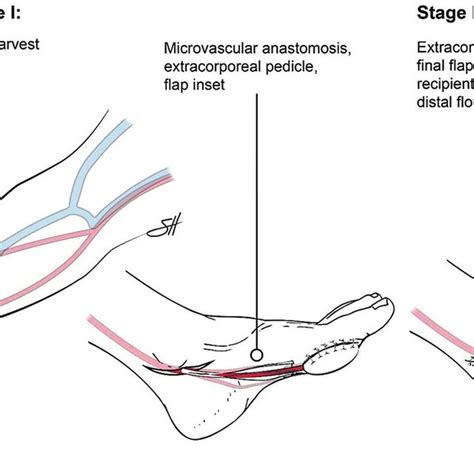 Pictorial Representation Of The Extracorporeal Pedicle Reconstruction