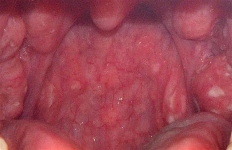 Bumps On Tonsils