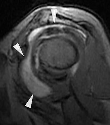 MedView Medical Imaging Consultancy Info Page: Shoulder Bursitis