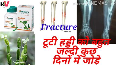 Hadjod Herbal Medicine टूटी हड्डी जोड़े Ayurveda Bone Fractureartho