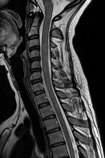 Adult Pyogenic Vertebral Osteomyelitis Spine Orthobullets