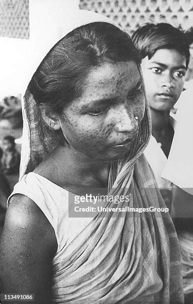 13 Smallpox Scars Stock Photos, High-Res Pictures, and Images - Getty ...