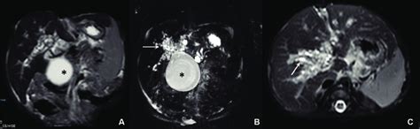 Peribiliary Cysts In A Pediatric Patient With Type I Choledochal Cyst