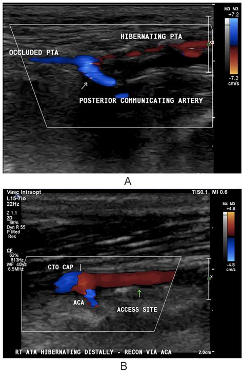 Pedal Flow Hemodynamics In Patients With Chronic Limb Threatening