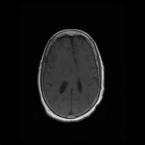 Solitary Fibrous Tumor Hemangiopericytoma Image Radiopaedia Org