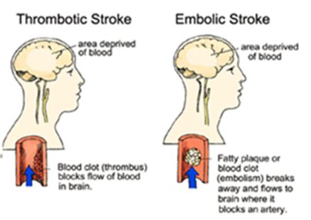 Med Surg Strokes Flashcards Quizlet