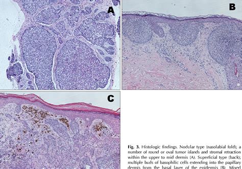 Nevoid Basal Cell Carcinoma Syndrome Histology