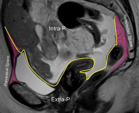 Mri Of Tumors And Tumor Mimics In The Female Pelvis Anatomic Pelvic