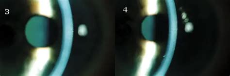 A Curious Case Of Corneal Edema American Academy Of Ophthalmology