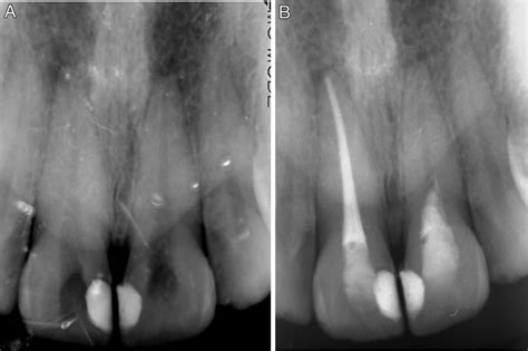 A Mature Carious Tooth 21 With A Periapical Radiolucency A The