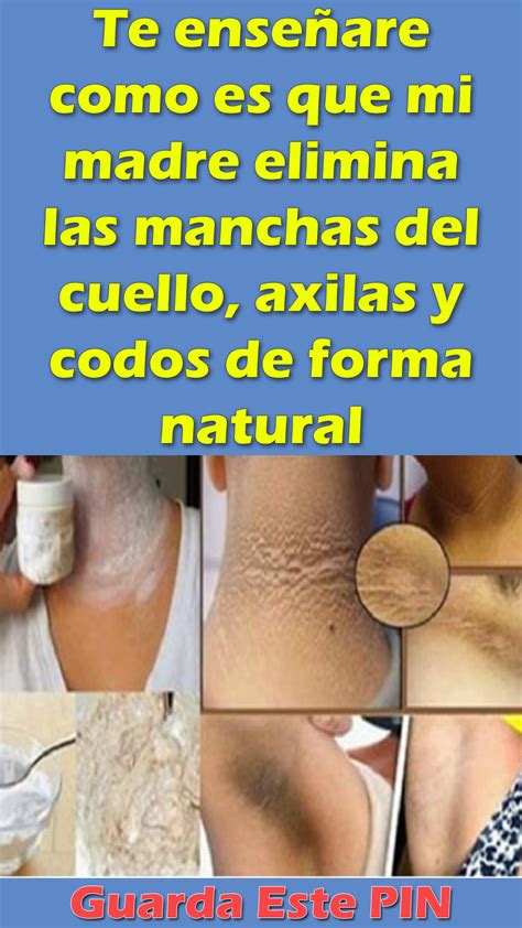 Te Ense Are Como Es Que Mi Madre Elimina Las Manchas Del Cuello Axilas