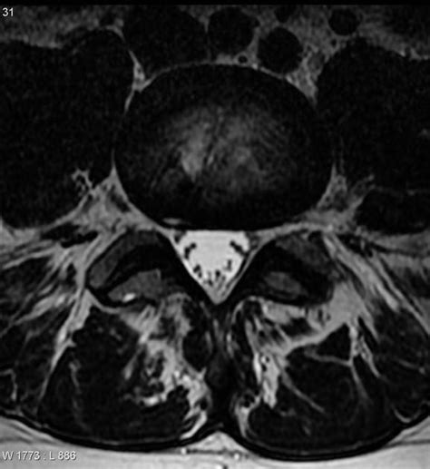 Annular fissure - Many authors prefer the term annular fissure over ...