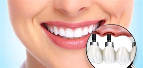 Types Of Dental Veneers Which One Is Right For You Vcd Medical