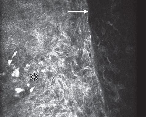 Ocular Surface Tumor Diagnostics