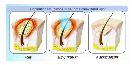 Blue Light Photodynamic Therapy For Acne Shelly Lighting