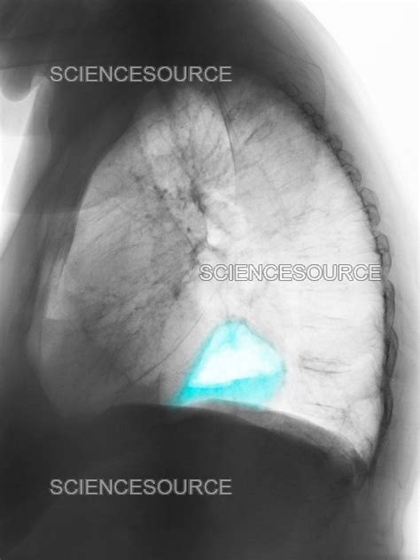 photograph hiatal hernia science source images