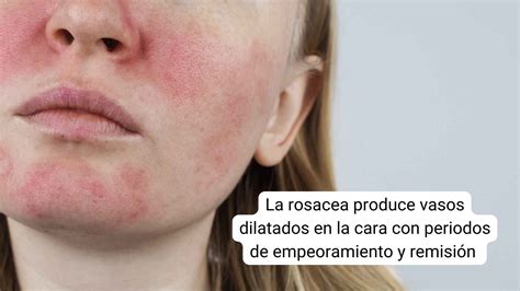 Rosácea Causas Síntomas Y Tratamientos Para Controlarla