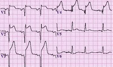 Top 5 MI ECG Patterns You Must Know | LearntheHeart.com