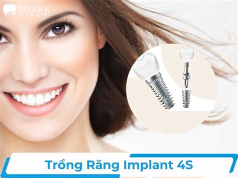 Trồng răng implant 4S là gì Có những ưu điểm nổi bật nào