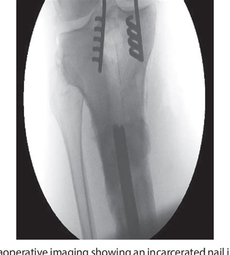 Figure 1 From A Novel Surgical Technique For Extraction Of A Firmly