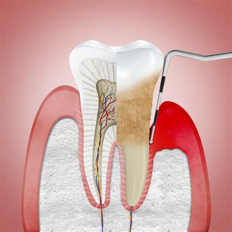 Periodontite Dentista Porto Alegre Zona Norte Hera Odontologia