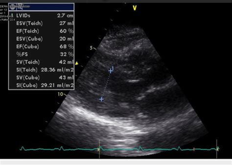 Two Dimensional Echocardiogram Showing Normal Biventricular Dimensions