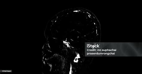 Mrv Brain Or Magnetic Resonance Venography Of The Brain For Diagnosis