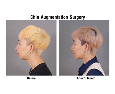 เสริมคาง - Dr.CHEN Surgery Hospital International Center 