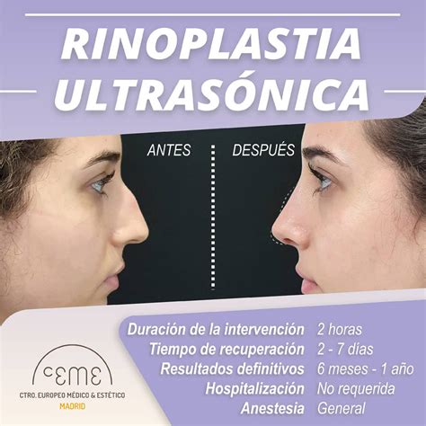 Rinoplastia Ultrasónica Antes Y Después En Centro Ceme