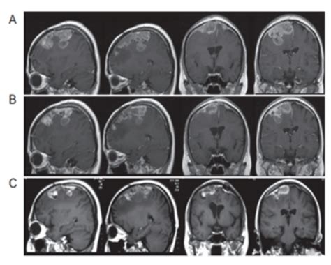 A 25 Year Old Woman Who Had Recurrent Rhabdoid Meningioma Was Treated