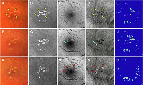 Multimodal Imaging Of The Left Eye Of A Year Old Woman Obtained Over