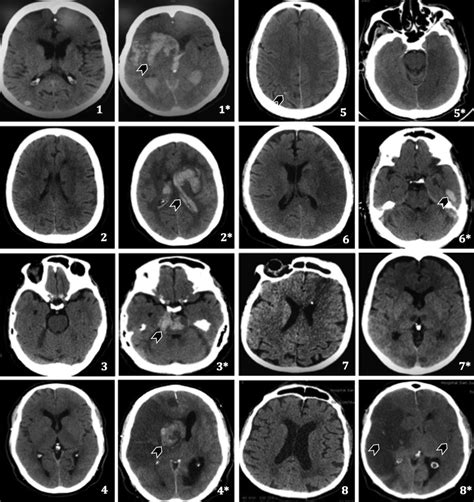 Tomografía Computarizada Del Cerebro