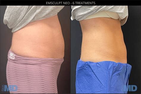 Emsculpt Neo Before After Photos Skin Md