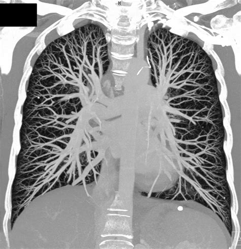 Volume Rendering Versus Maximum Intensity Projection In Ct Angiography